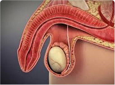Erectile Dysfunction